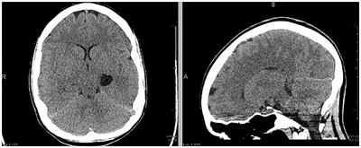 Management of Cerebral Herniation Secondary to Lead Encephalopathy: A Case Report